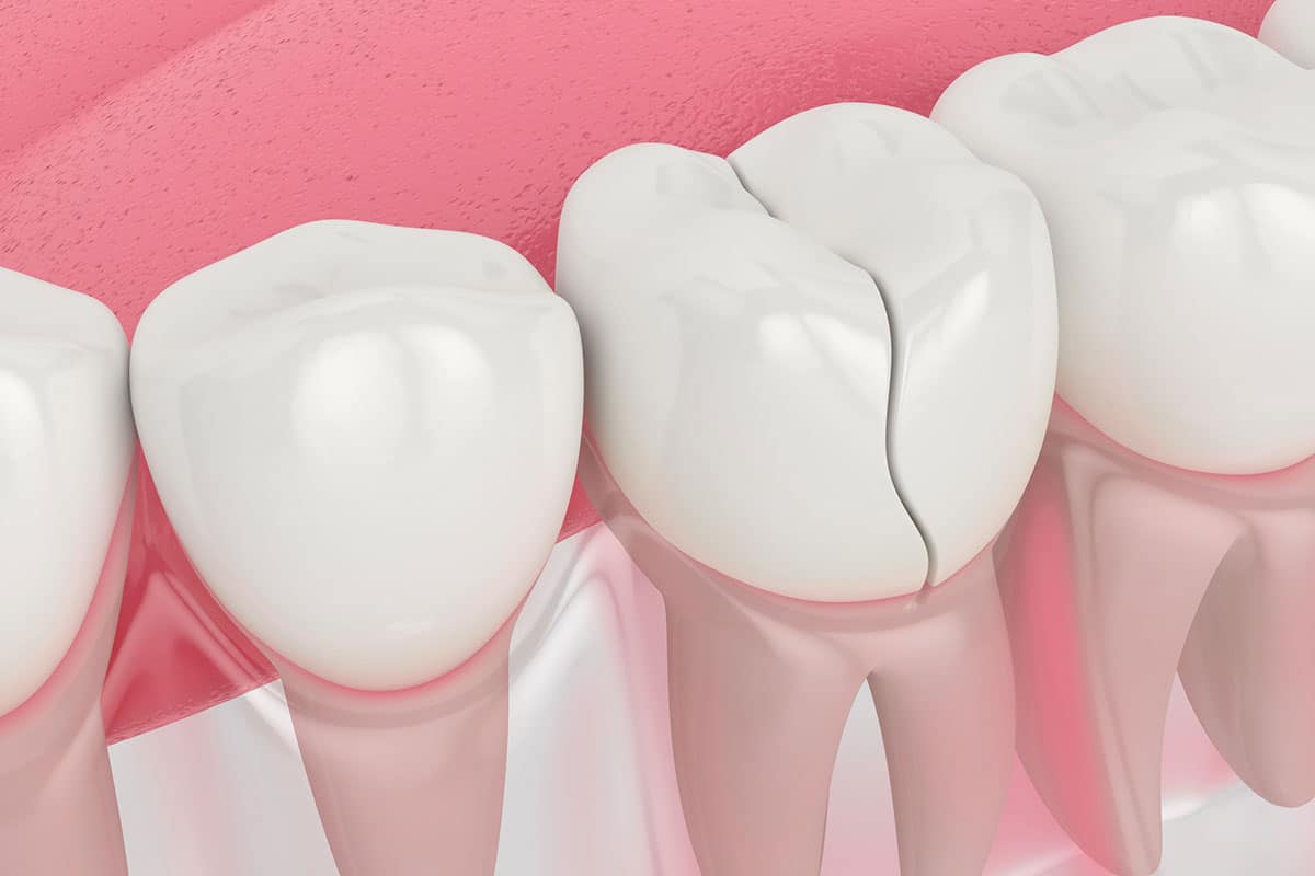 How Does An Endodontist Repair A Cracked Tooth Blog